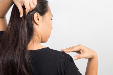 How to get rid of dandruff quickly: 17 ways